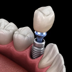 A digital image that shows a dental implant sitting on the lower arch of the mouth between natural, healthy teeth