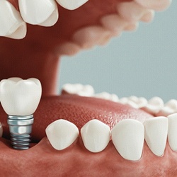 A digital image of a dental implant being placed into a vacated socket on the lower arch of the mouth