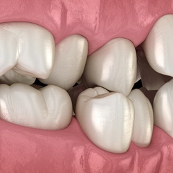 A crossbite image