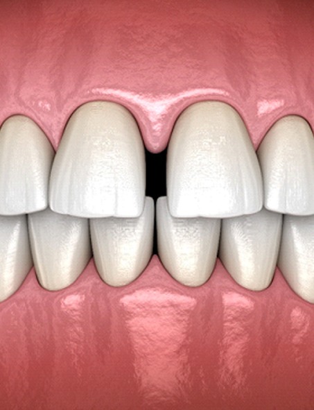 gapped teeth