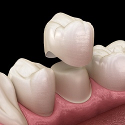 Digital image of a dental crown being placed over a natural tooth on the bottom arch of teeth