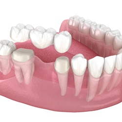 Digital image of a fixed dental bridge being placed on the bottom row of teeth to replace a single missing tooth