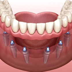 implant dentures in Myrtle Beach