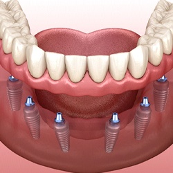 implant dentures
