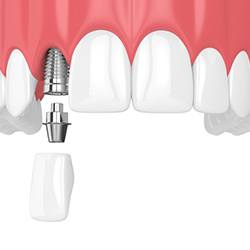 A single tooth dental implant sitting on the lower arch between two healthy teeth in Myrtle Beach