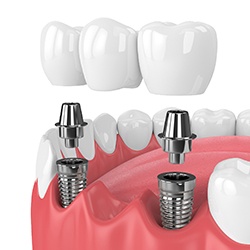 two dental implants holding a bridge in place