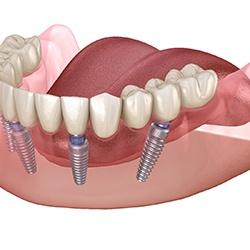 An implant bridge secured to six dental implants along the lower arch in Myrtle Beach