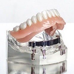 A bar-retained implant denture that is affixed to a mouth mold in Myrtle Beach