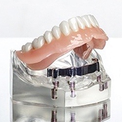 A bar-retained implant denture that is affixed to a mouth mold