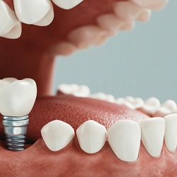 A digital image of a dental implant being placed into a vacated socket on the lower arch of the mouth