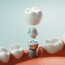 A digital image of the metal abutment that connects the restoration to the dental implant