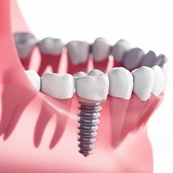 single dental implant post in the jawbone