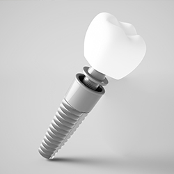 Animation of implant supported dental crown