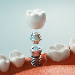 A digital image of the metal abutment that connects the restoration to the dental implant