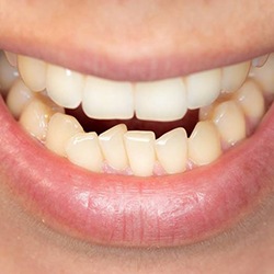 Closeup of crooked crowded teeth