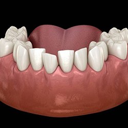 Diagram of crowded teeth