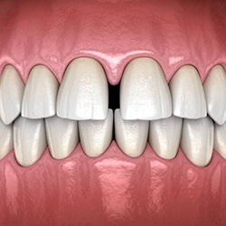 Diagram showing gaps between teeth