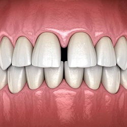 Diagram showing gaps between teeth in Myrtle Beach