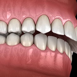 Diagram of overbite before Invisalign