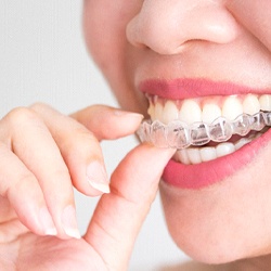 A person inserting a clear Invisalign aligner into the top arch of their smile