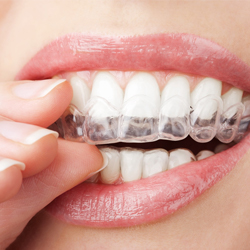 A person wearing Invisalign