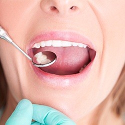 Closeup of patient receiving dental exam