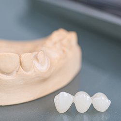 Custom crafted dental bridge