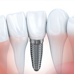 Animation of implant supported dental crown