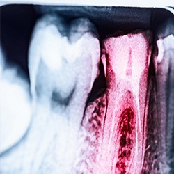 X-ray of root canal treated tooth