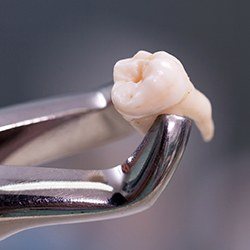 Metal clasp holding extracted tooth