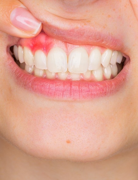 A woman holding up her top lip to expose red, inflamed soft tissue that needs gum disease therapy in Myrtle Beach