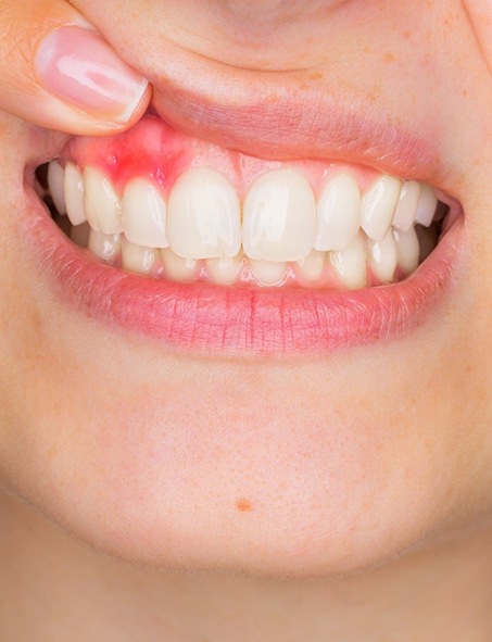 A woman holding up her top lip to expose red, inflamed soft tissue