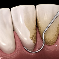 Digital image of a dental tool removing hardened plaque and tartar from a tooth