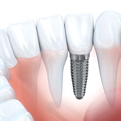 single dental implant