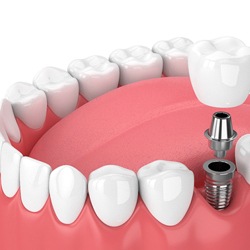 one dental implant