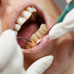 soft tissue laser gums