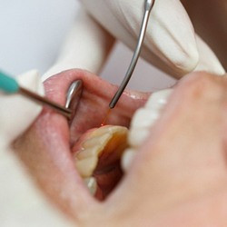 gum disease therapy laser