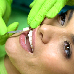 A woman having porcelain veneers placed