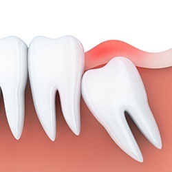 Animation of impacted wisdom tooth