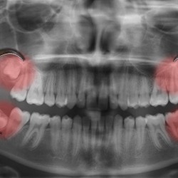 Dental X-ray of wisdom teeth in Myrtle Beach