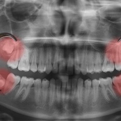 Dental X-ray of wisdom teeth