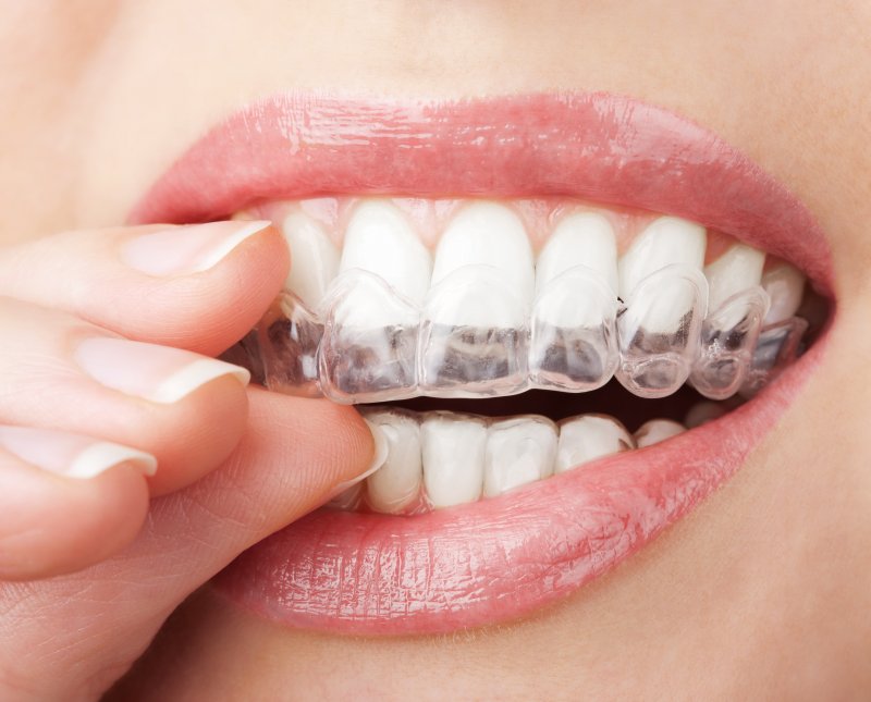 a woman putting in an Invisalign aligner