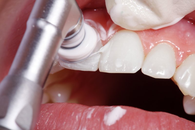an up-close image of a dental instrument cleaning a patient’s teeth during an appointment