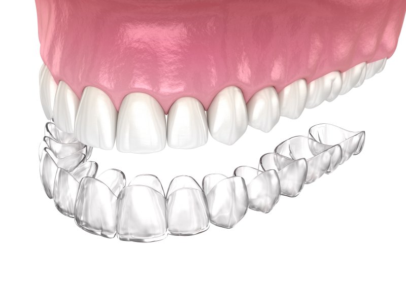 a digital image of an Invisalign aligner preparing to go on over the top arch of teeth